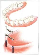 Implantaat laten zetten bij PPI in Hoorn